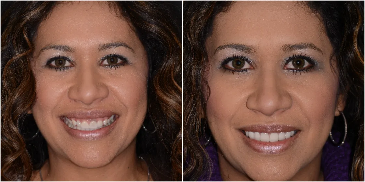Before and after smile transformation case 7 at Pybus Dental in Amarillo, TX