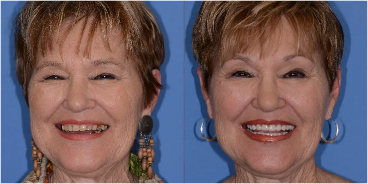 Before and after smile transformation case 8 at Pybus Dental in Amarillo, TX