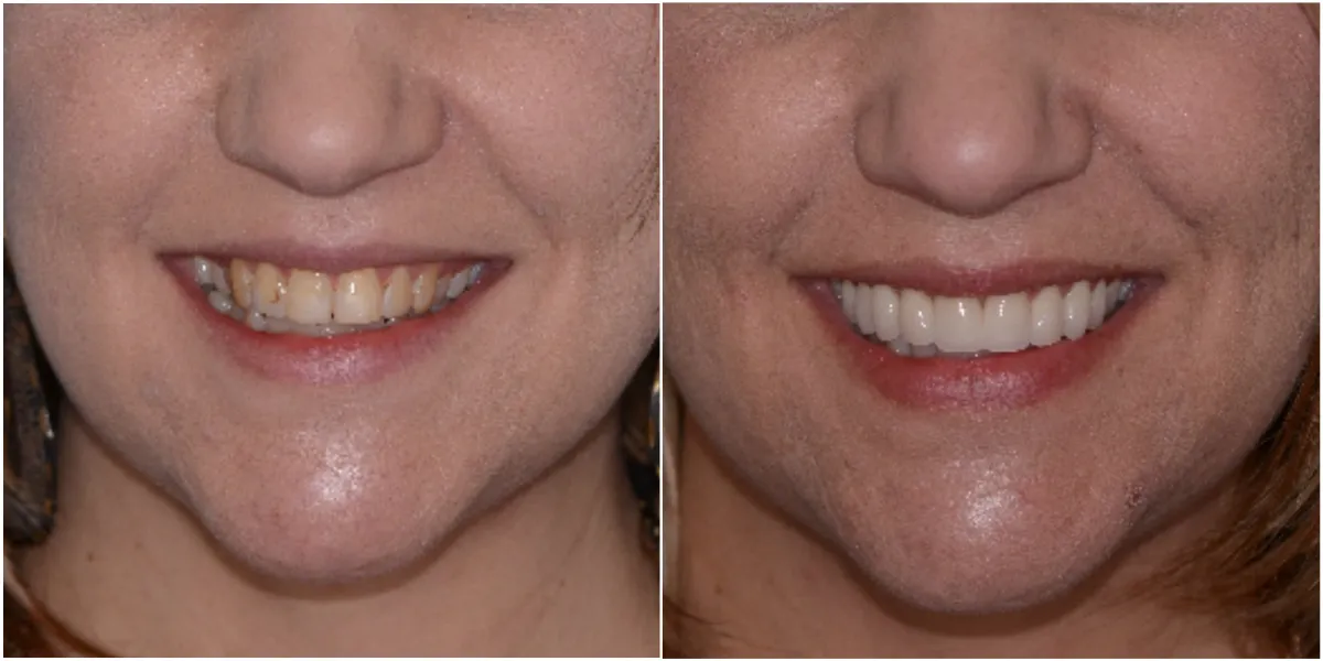 Before and after smile transformation case 9 at Pybus Dental in Amarillo, TX