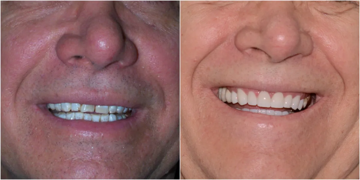 Before and after smile transformation case 10 at Pybus Dental in Amarillo, TX