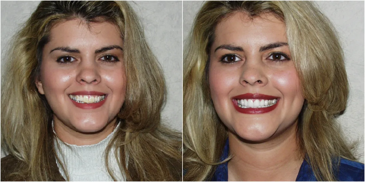 Before and after smile transformation case 11 at Pybus Dental in Amarillo, TX