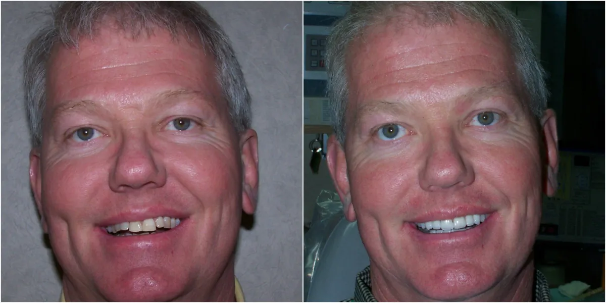 Before and after smile transformation case 12 at Pybus Dental in Amarillo, TX