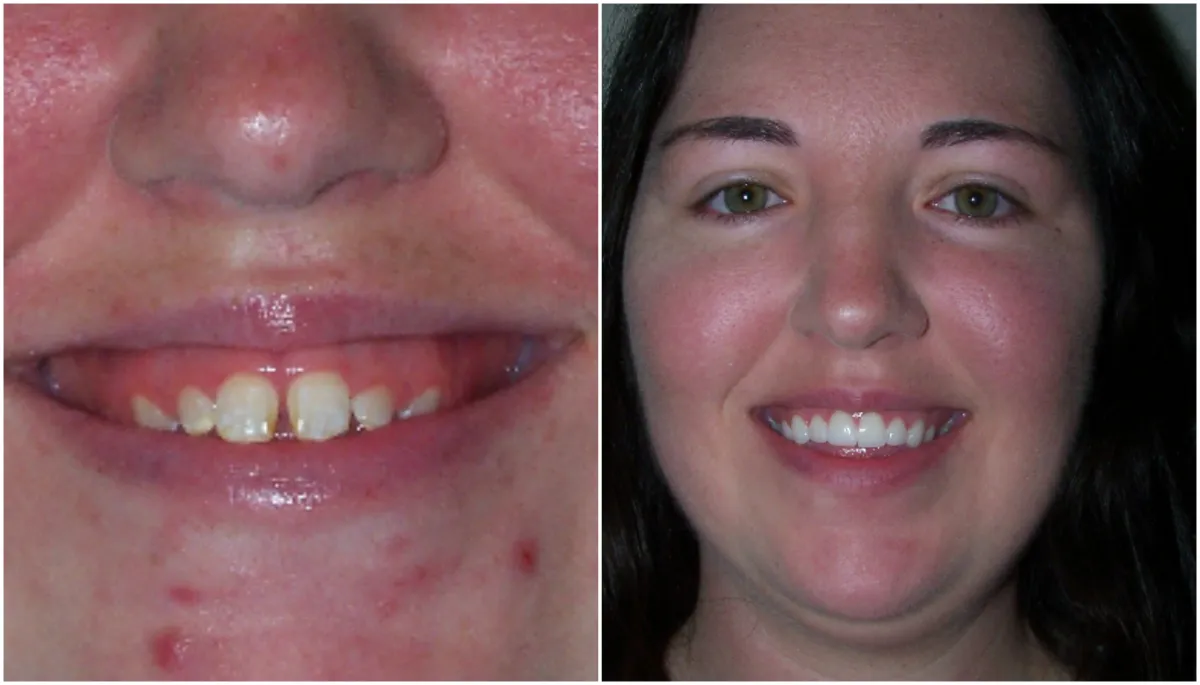 Before and after smile transformation case 14 at Pybus Dental in Amarillo, TX