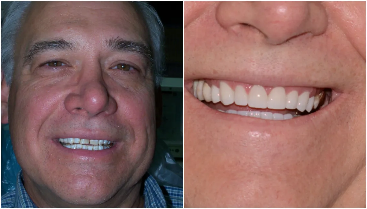 Before and after smile transformation case 15 at Pybus Dental in Amarillo, TX