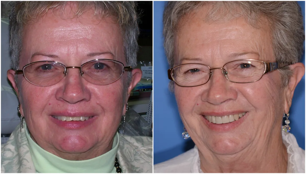 Before and after smile transformation case 16 at Pybus Dental in Amarillo, TX