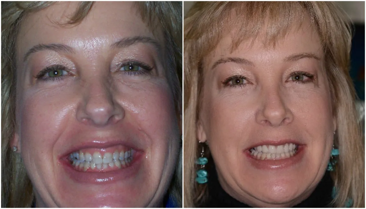 Before and after smile transformation case 17 at Pybus Dental in Amarillo, TX