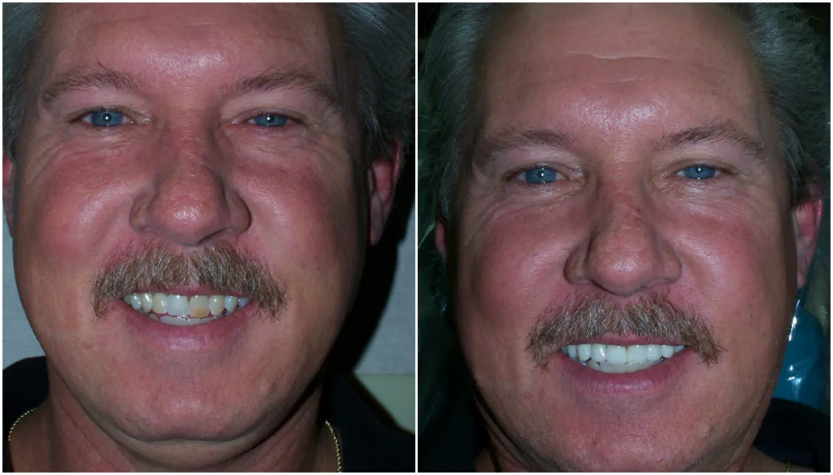 Before and after smile transformation case 18 at Pybus Dental in Amarillo, TX