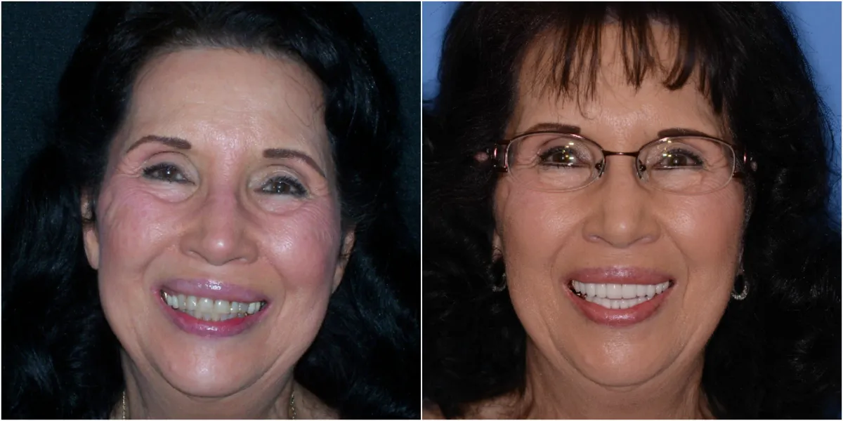 Before and after smile transformation case 19 at Pybus Dental in Amarillo, TX