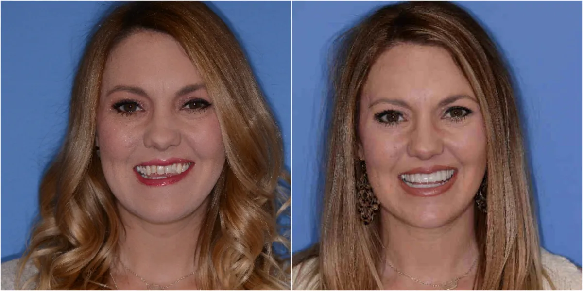 Before and after smile transformation case 20 at Pybus Dental in Amarillo, TX