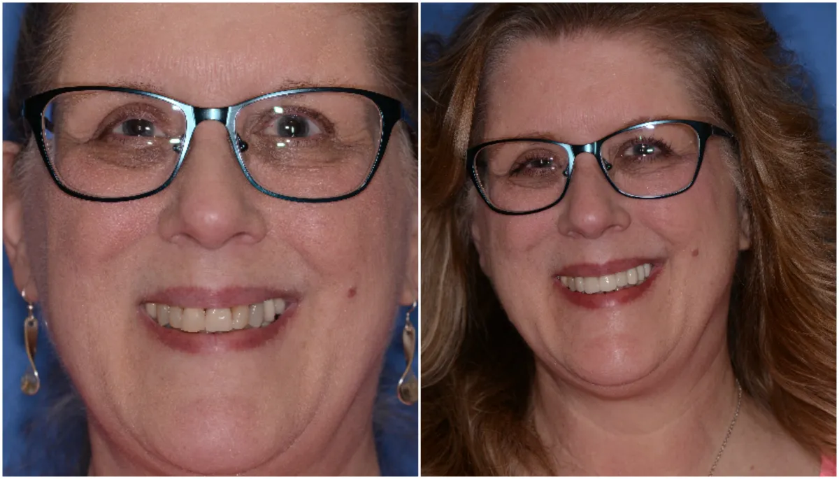 Before and after smile transformation case 21 at Pybus Dental in Amarillo, TX