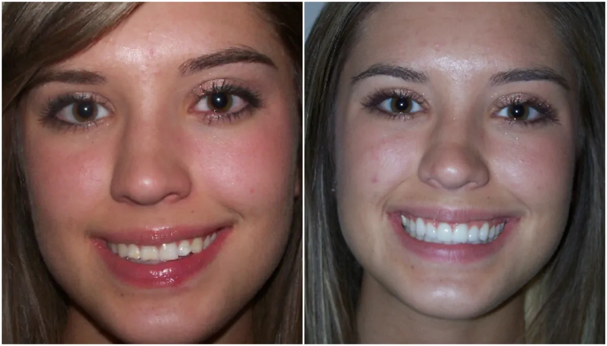 Before and after smile transformation case 22 at Pybus Dental in Amarillo, TX