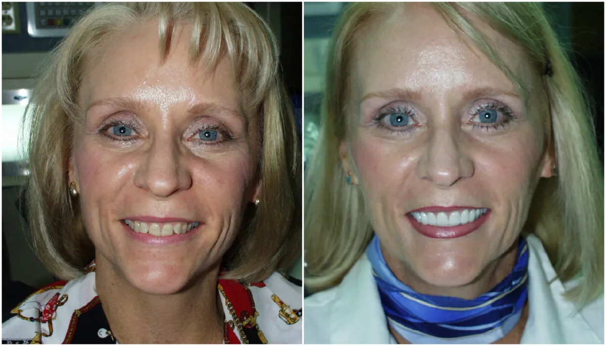 Before and after smile transformation case 23 at Pybus Dental in Amarillo, TX
