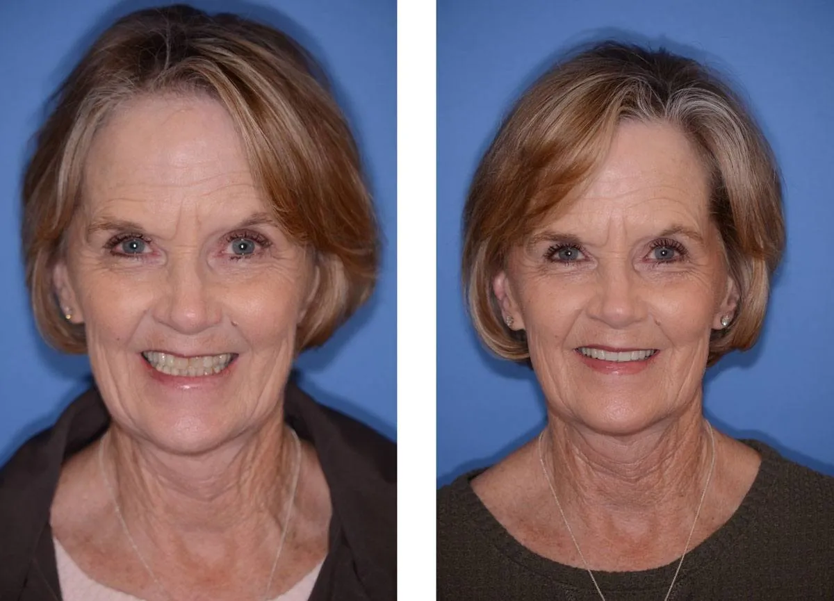 Before and after smile transformation case 24 at Pybus Dental in Amarillo, TX