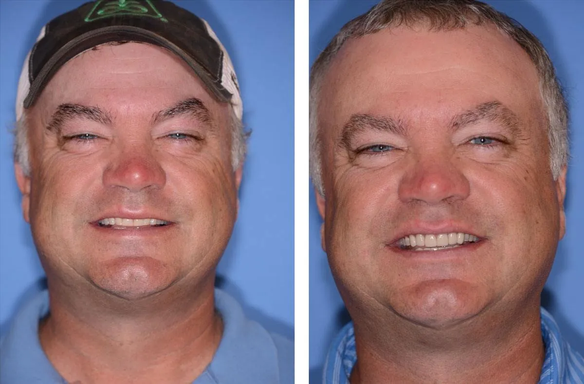 Before and after smile transformation case 25 at Pybus Dental in Amarillo, TX