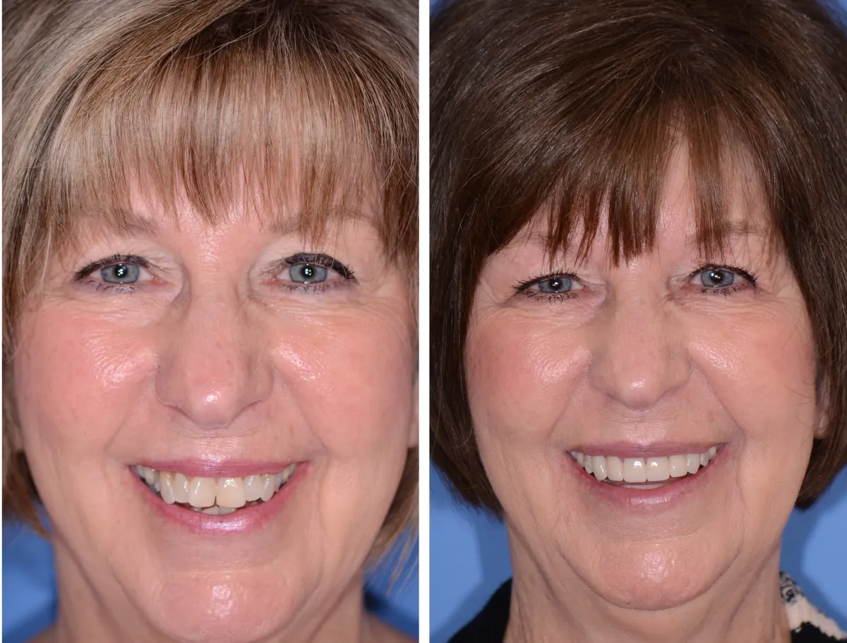 Before and after smile transformation case 26 at Pybus Dental in Amarillo, TX