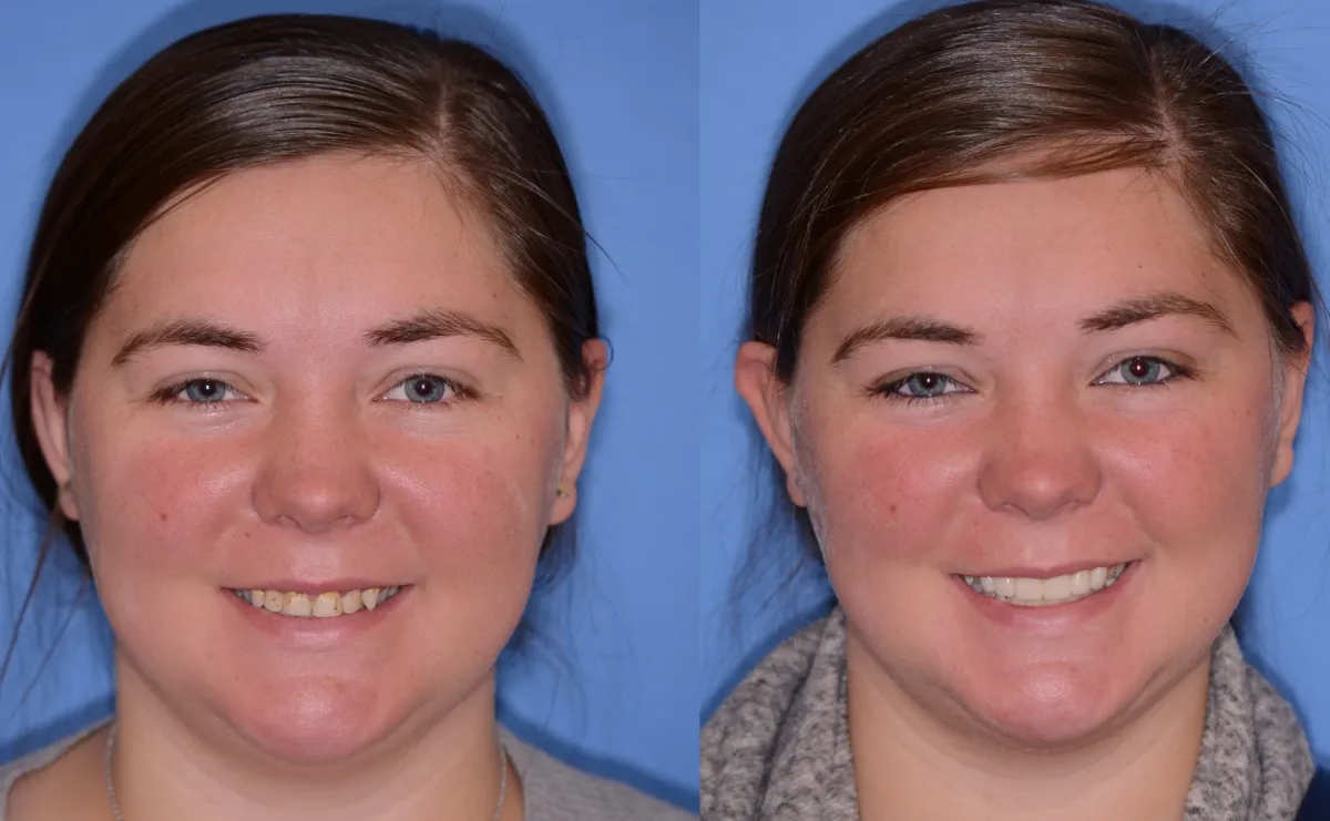Before and after smile transformation case 27 at Pybus Dental in Amarillo, TX