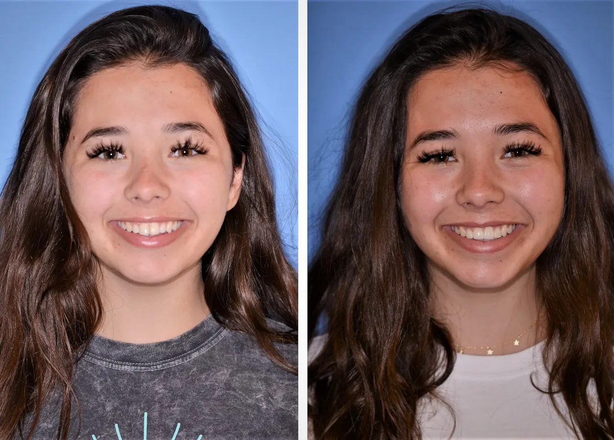 Before and after smile transformation case 28 at Pybus Dental in Amarillo, TX