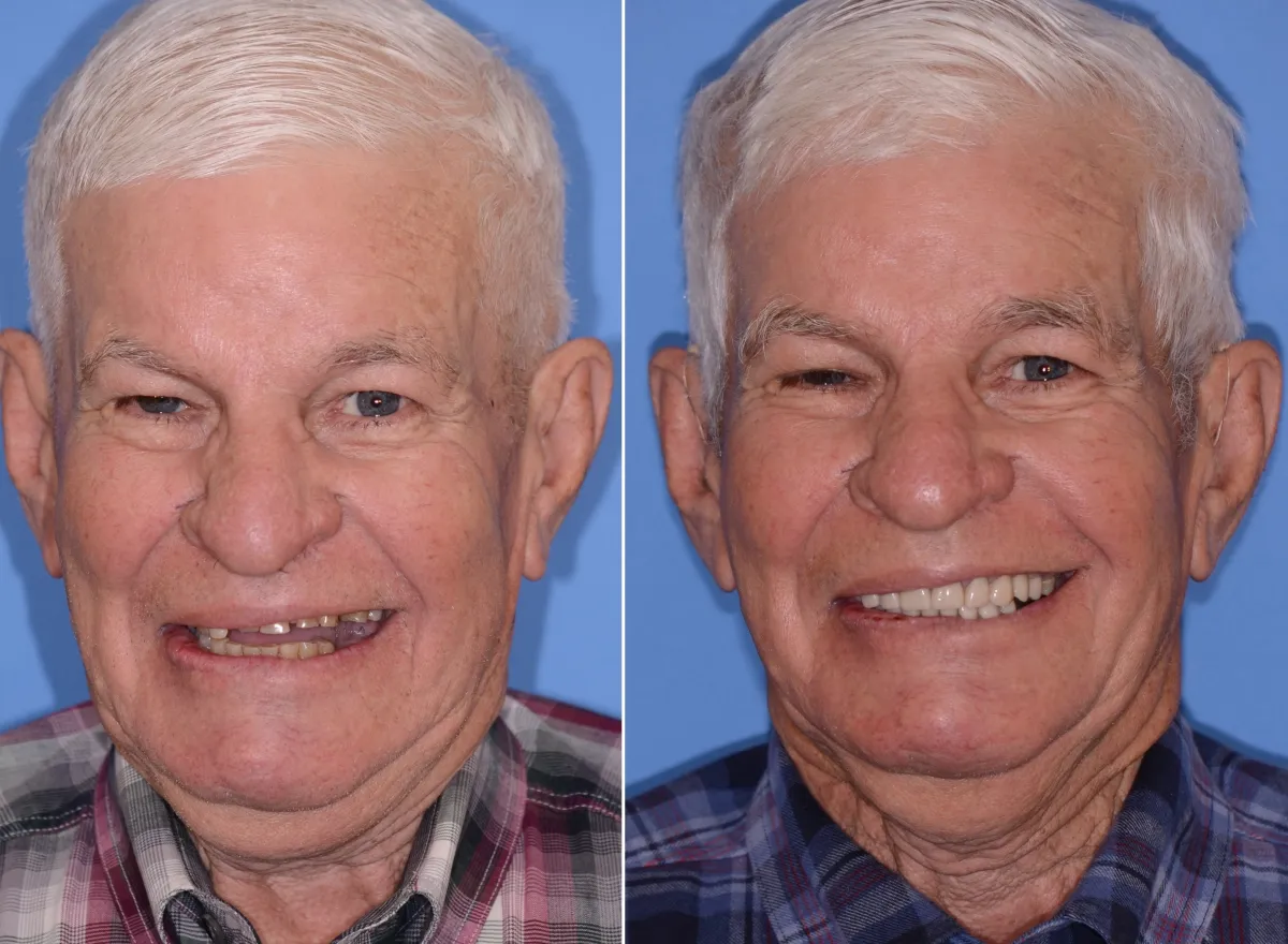 Before and after smile transformation case 29 at Pybus Dental in Amarillo, TX