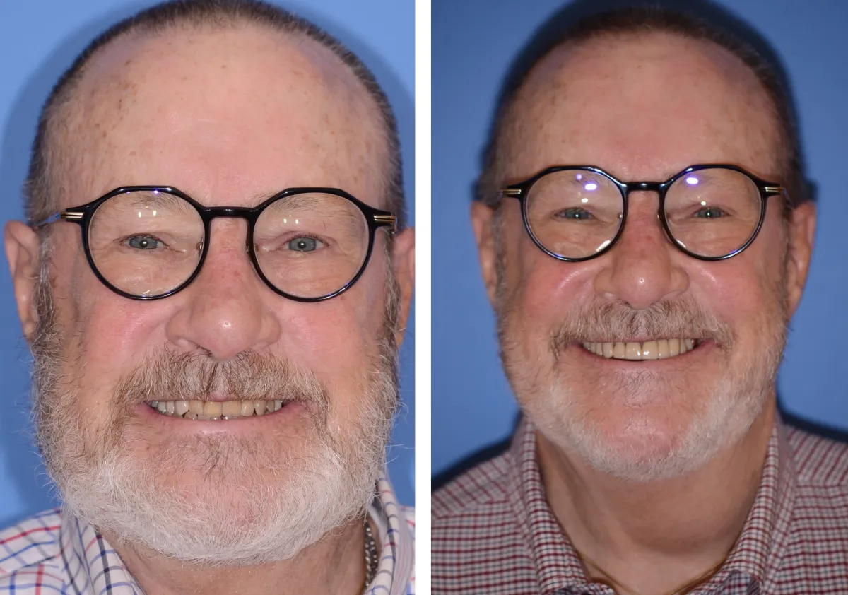 Before and after smile transformation case 30 at Pybus Dental in Amarillo, TX