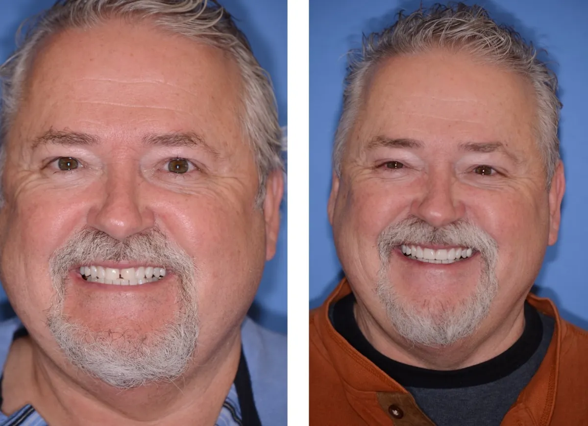 Before and after smile transformation case 31 at Pybus Dental in Amarillo, TX