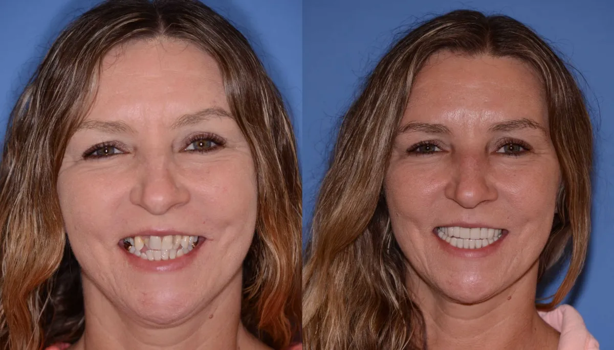 Before and after smile transformation case 32 at Pybus Dental in Amarillo, TX