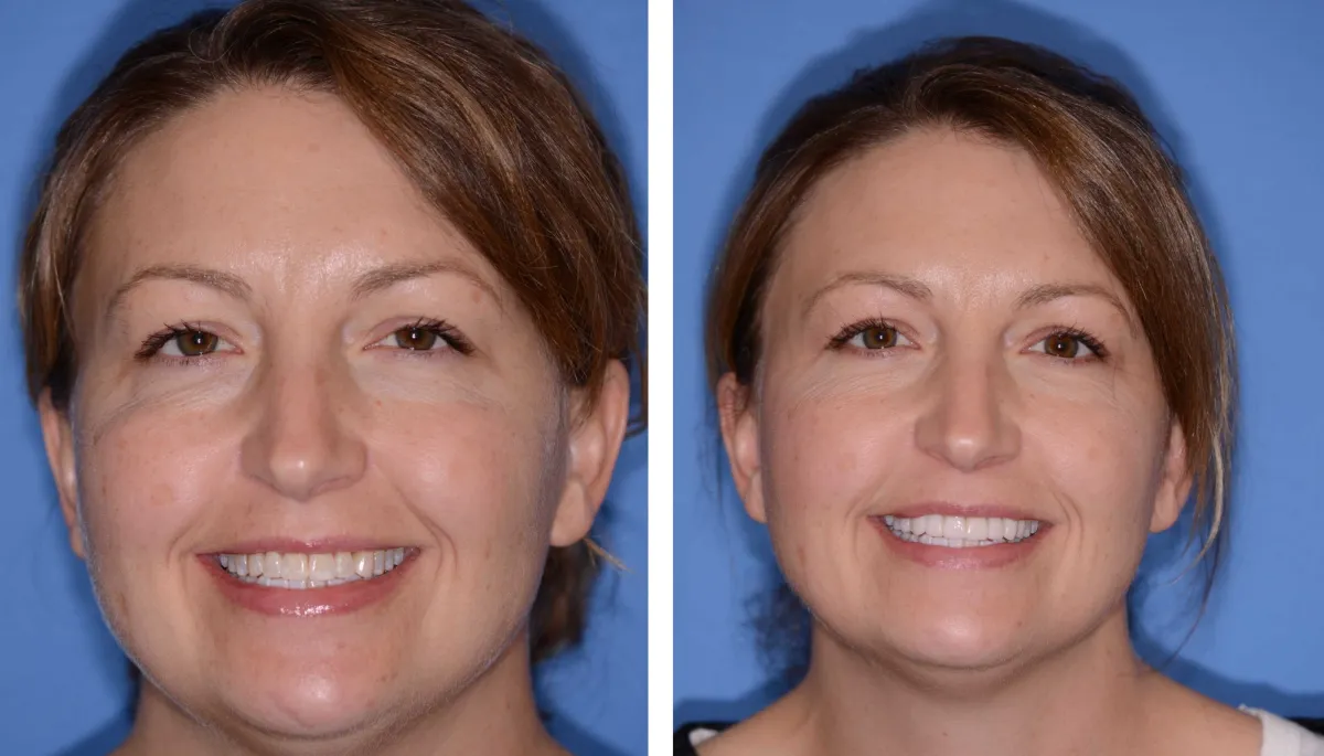 Before and after smile transformation case 33 at Pybus Dental in Amarillo, TX