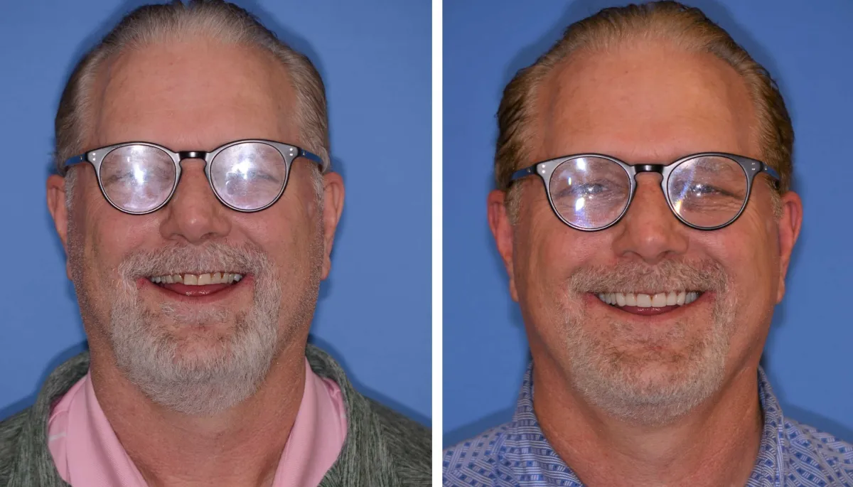 Before and after smile transformation case 34 at Pybus Dental in Amarillo, TX