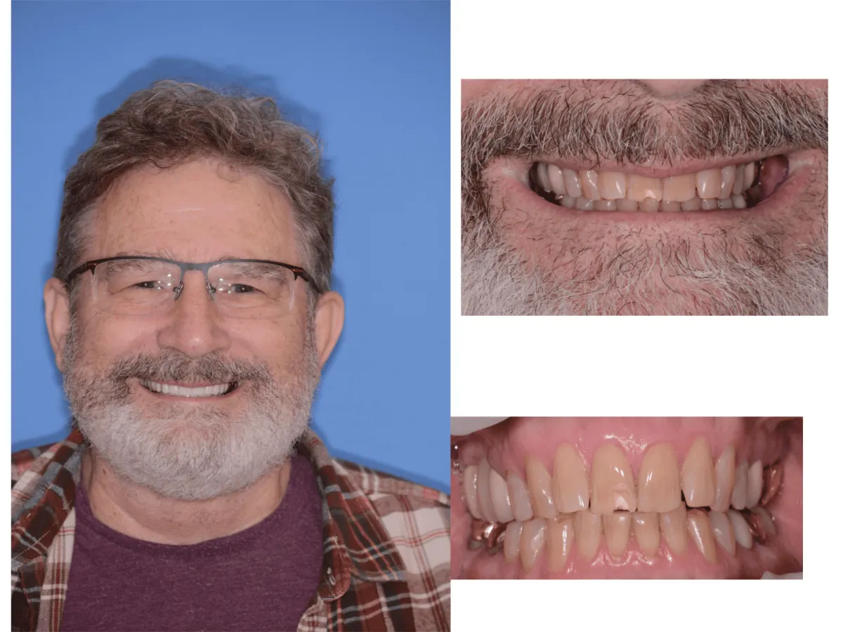 Before and after smile transformation case 36 at Pybus Dental in Amarillo, TX