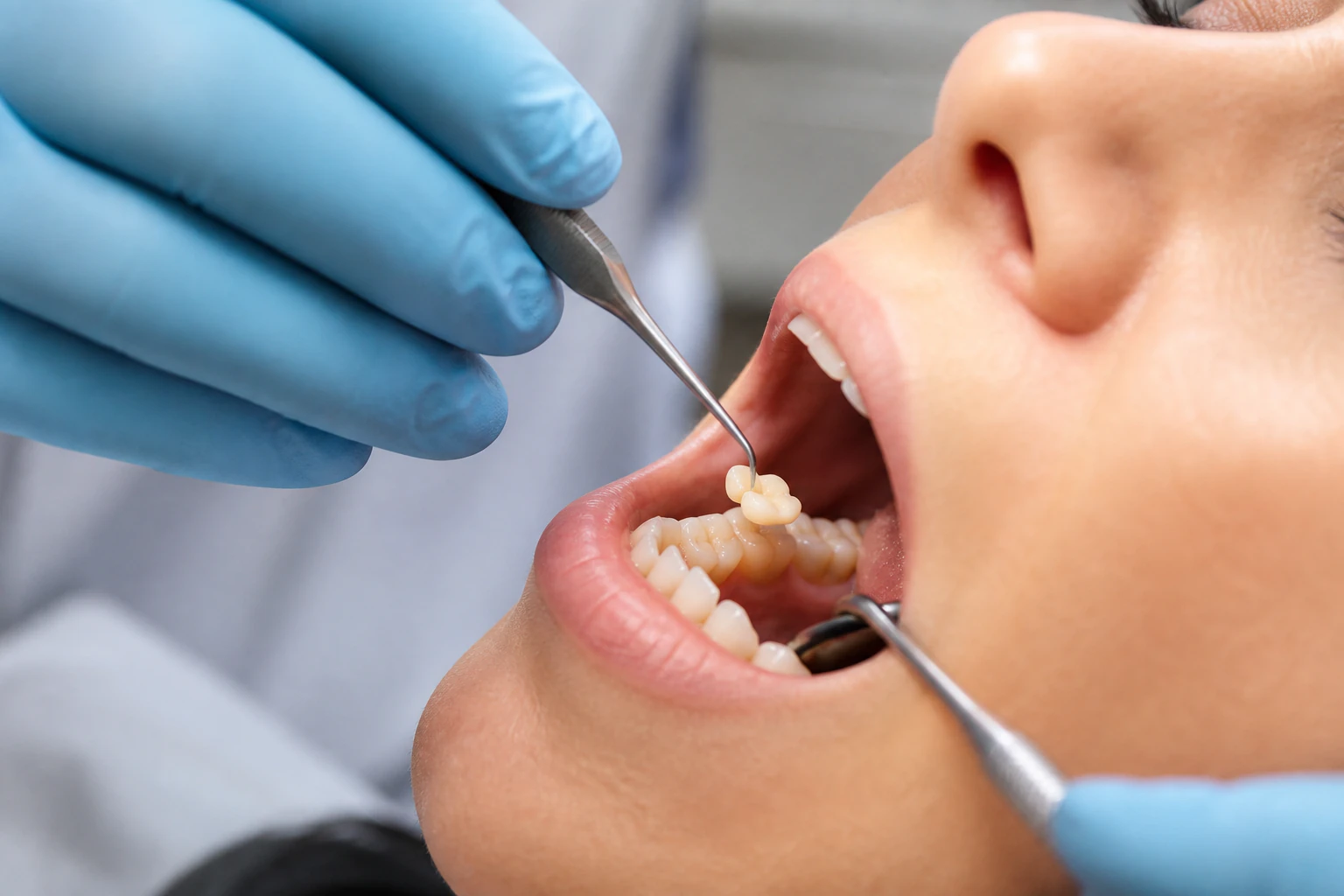 Dentist placing precision porcelain inlay restoration